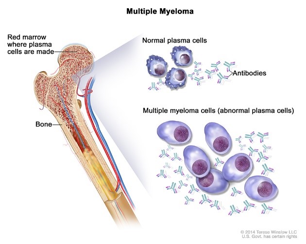 Myeloma | CDC